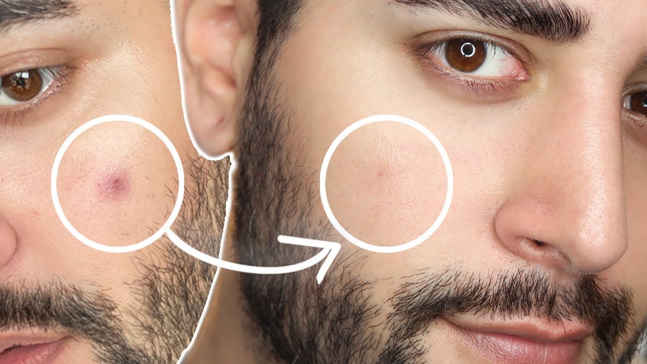 Dark Spots On Face