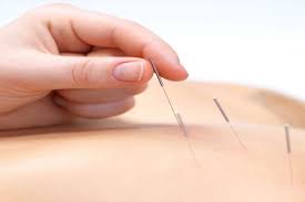 Dry needling therapy in Abbotsford